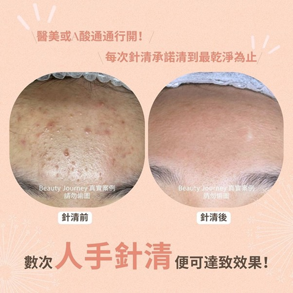 美容院針清去油脂粒