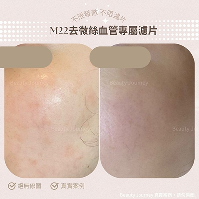 身醴去印焕膚療程效果