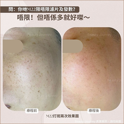 去印煥膚療程效果