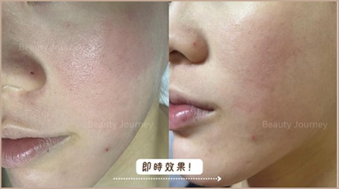 DEP 注氧滲透療程案例