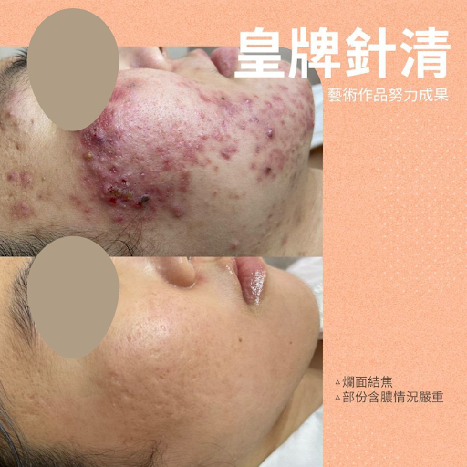 皇牌針清除粉刺療程效果