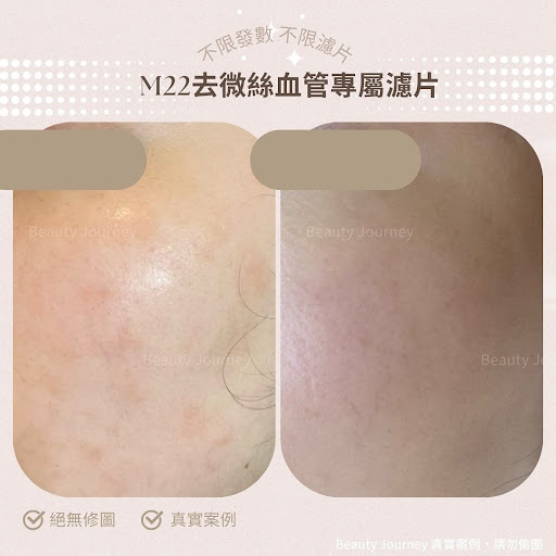 第七代 M22 光子嫩膚療程效果