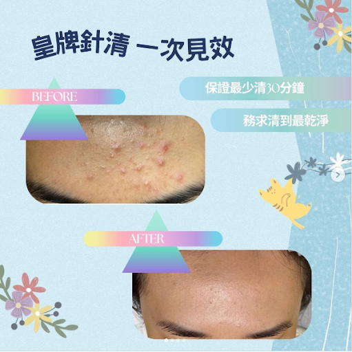 針清去油脂粒效果