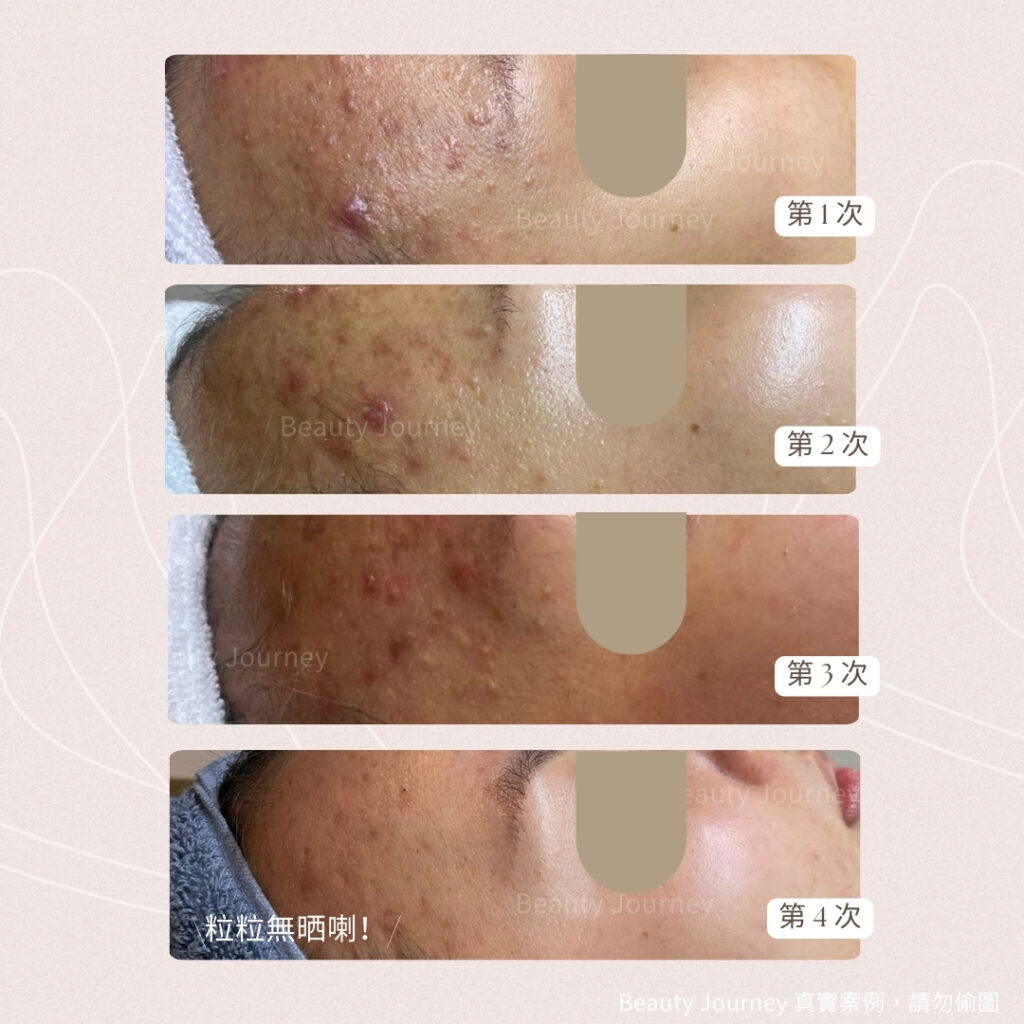 4次針清後暗瘡明顯減少