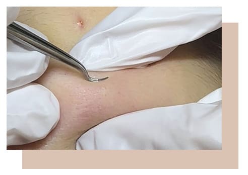 最受推介的針清療程