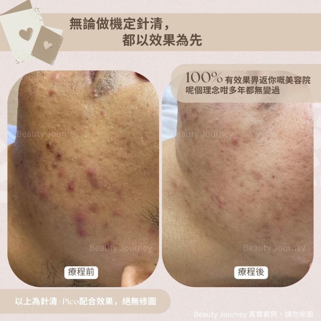 針清前後對比明顯